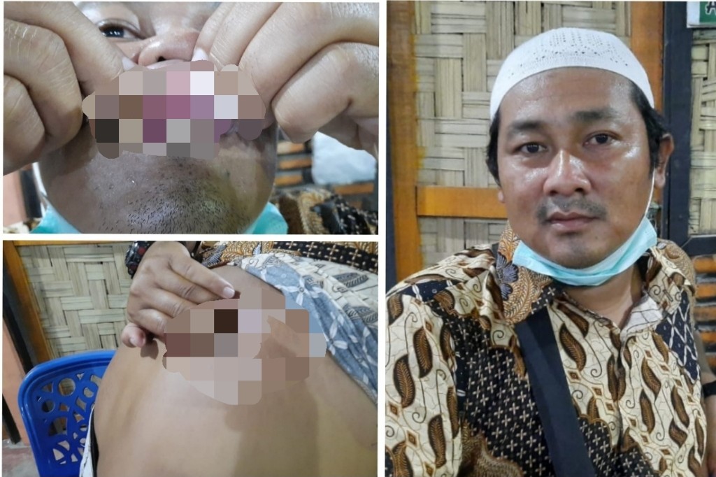 Liput Pemakaman Pasien Diduga Covid-19, Wartawan Dianiaya